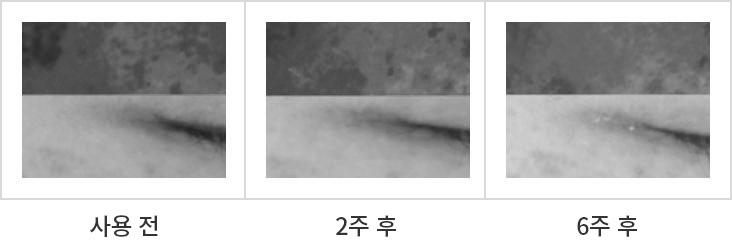 사용 전, 2주 후, 6주 후 비교 이미지